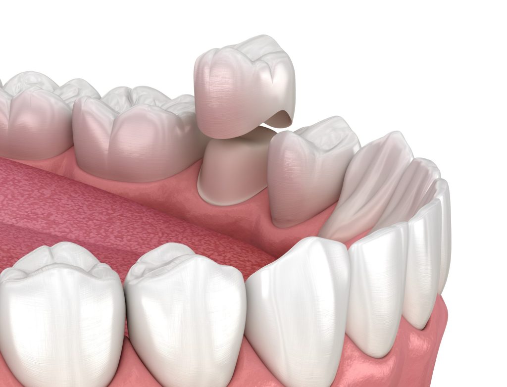 Dental Crown Problems: 5 Signs Your Crown Might Need Replacement