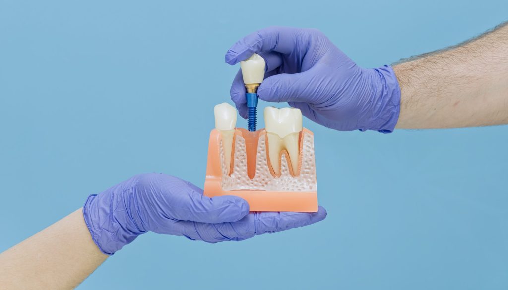What Happens Between Losing a Tooth and Getting an Implant? A Step-by-Step Look Patients Don’t Always See